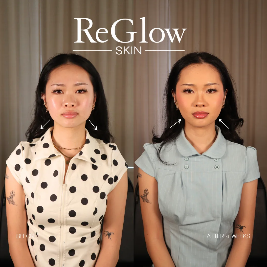 Before and after four weeks, front-facing, with arrows indicating the jawline
