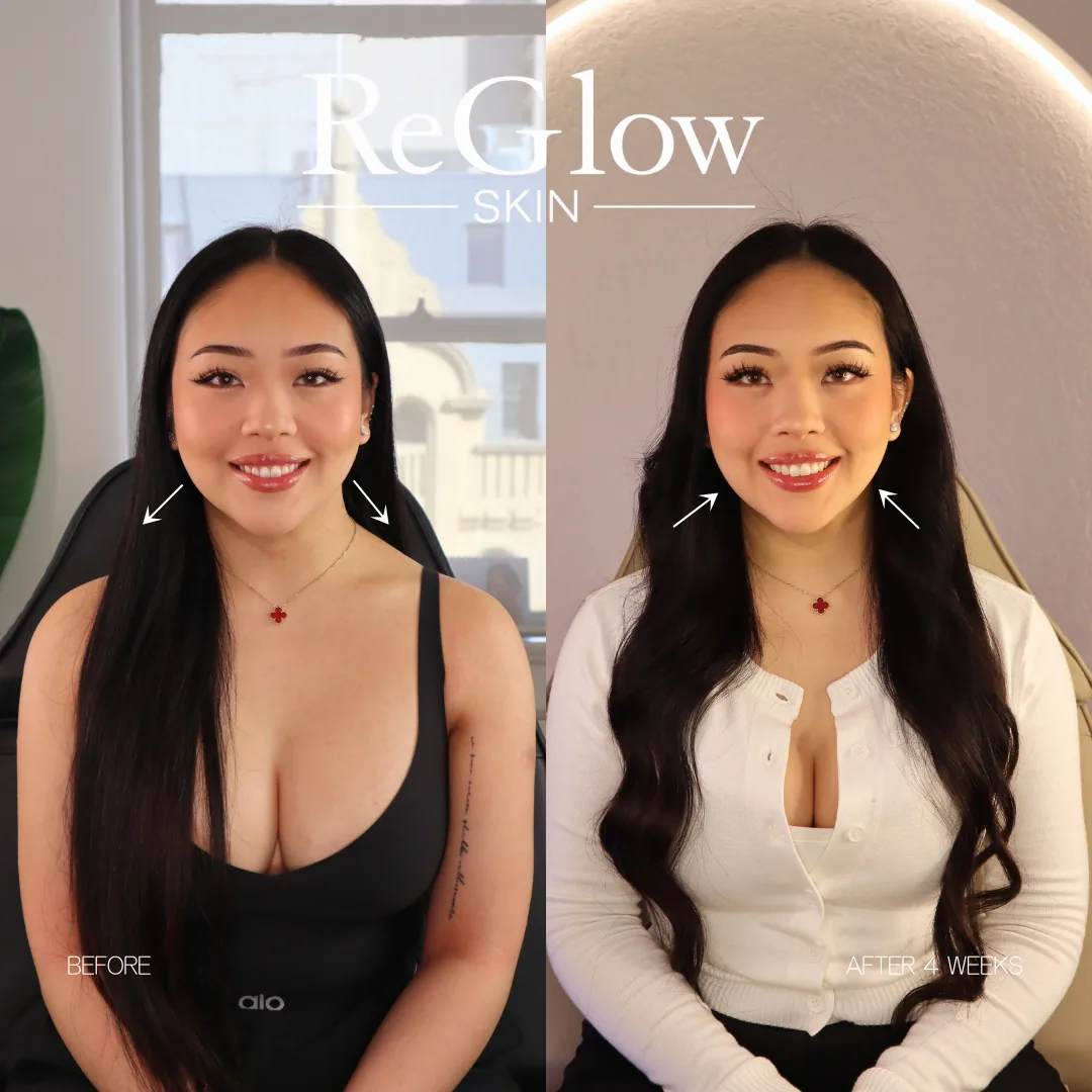 Before and after four weeks, front-facing and smiling, with arrows indicating the jawline