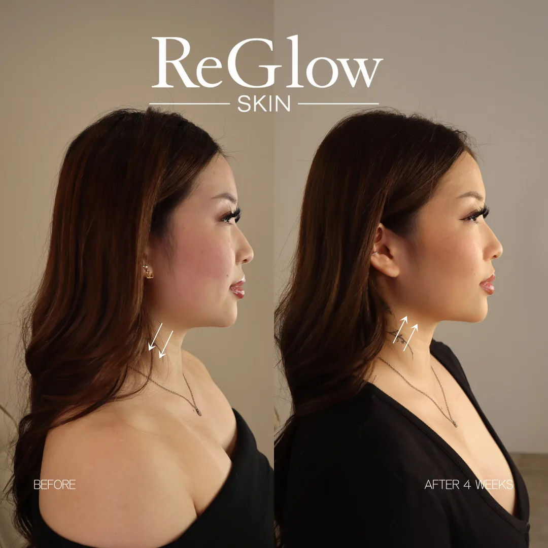 Before and after four weeks, side profile, with arrows indicating the jaw and neckline