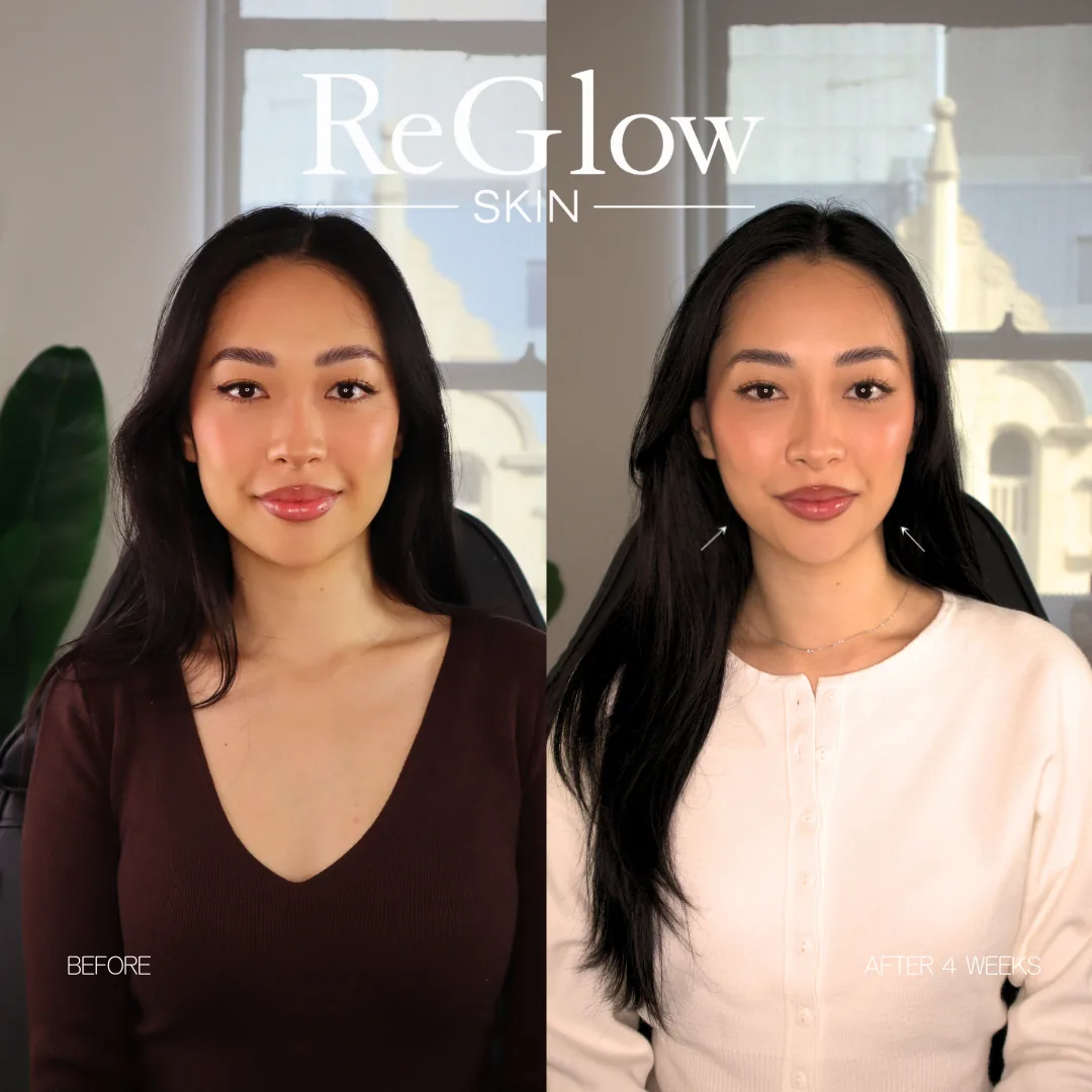 Before and after four weeks, front-facing, with arrows indicating the jawline