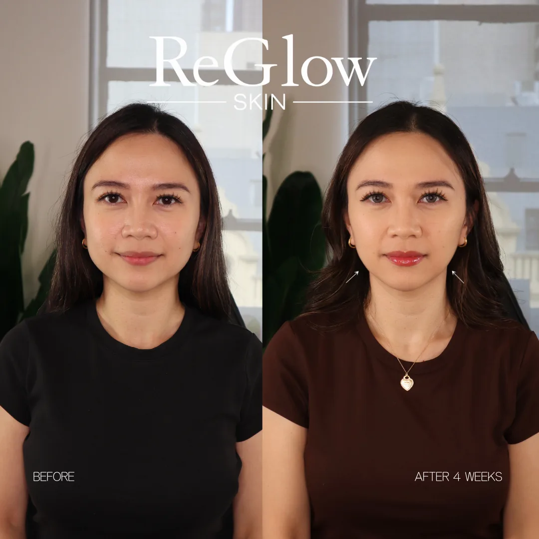 Before and after four weeks, front-facing, with arrows indicating the jawline