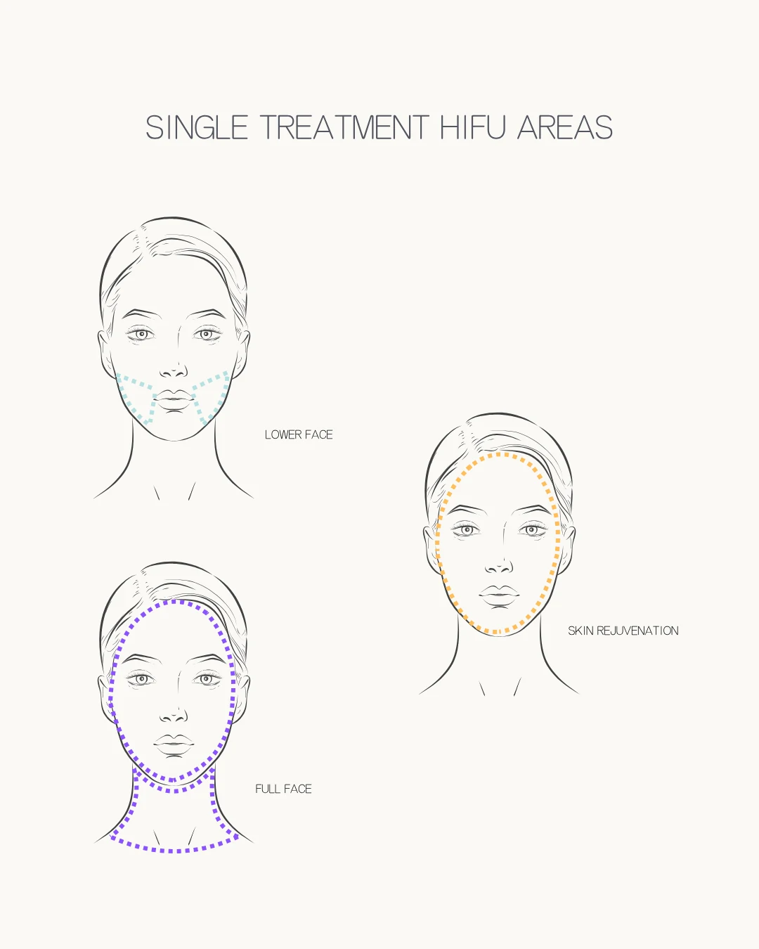 Ultraformer III HIFU applied across a full facial treatment area
