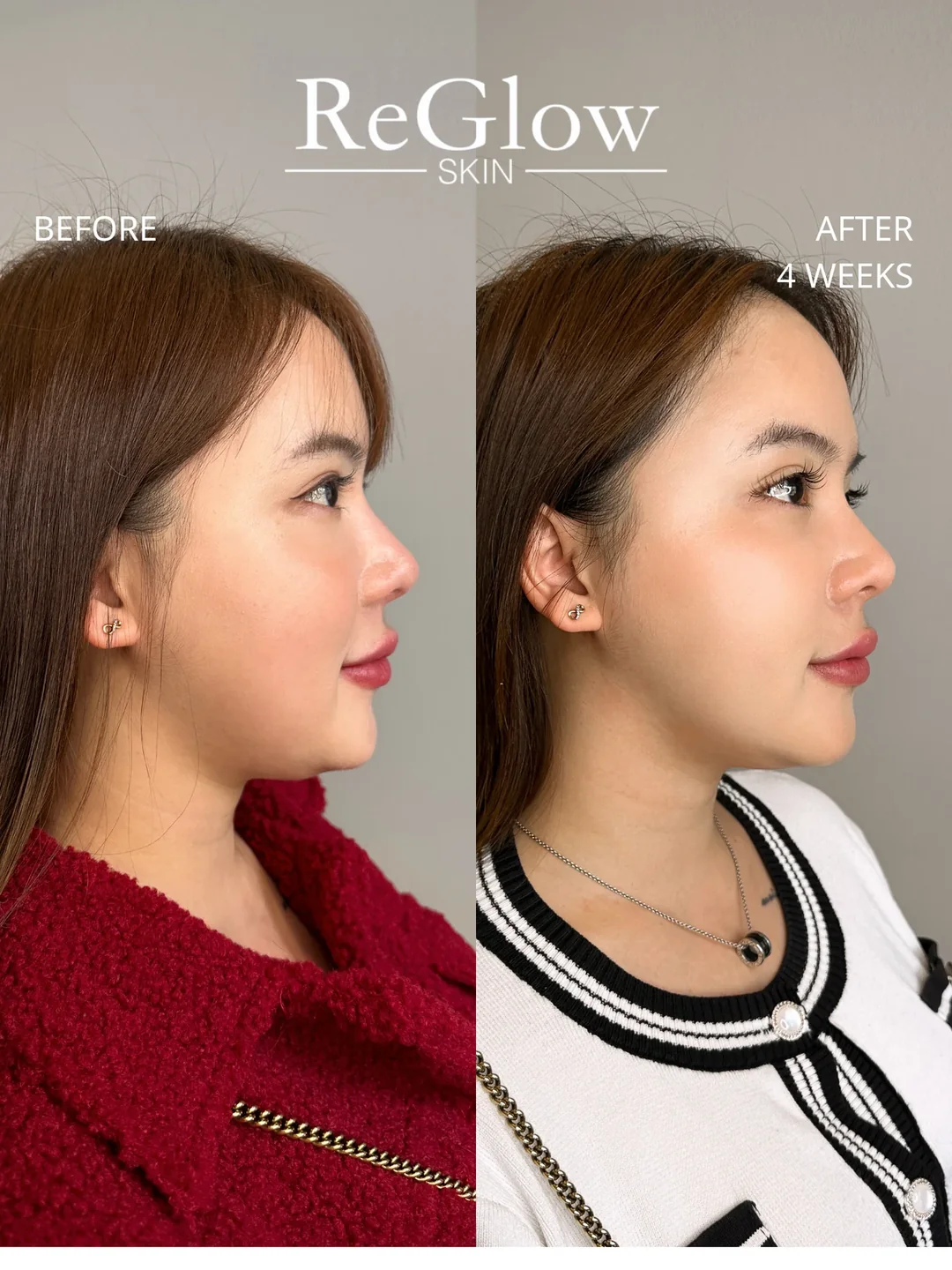 Ultraformer service imagery showing a profile comparison