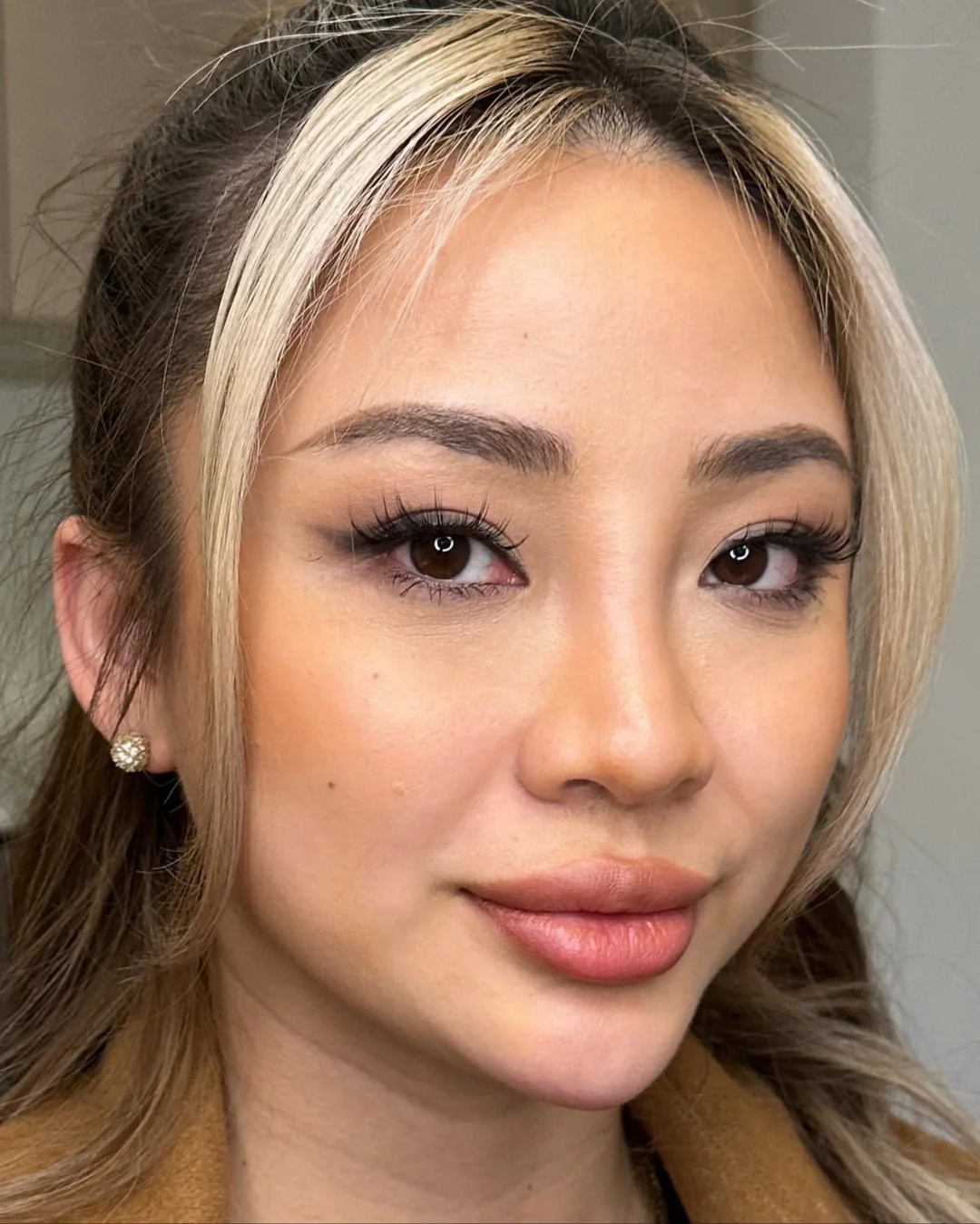 Smile lines running from nose to mouth corner, shown at an angle